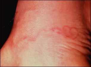 Larva migratoria cut&aacute;nea