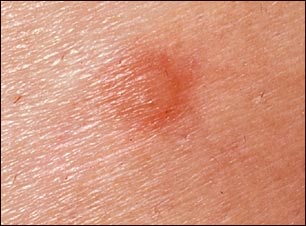 Vista de cerca de una picadura de pulga