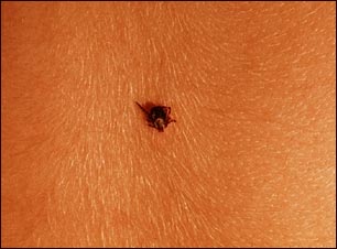 Garrapatas incrustadas en la piel