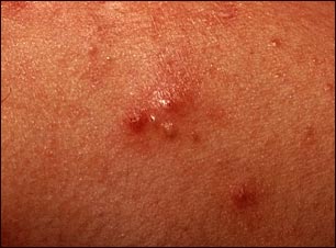 Acn&eacute; vista de cerca de lesiones pustulosas