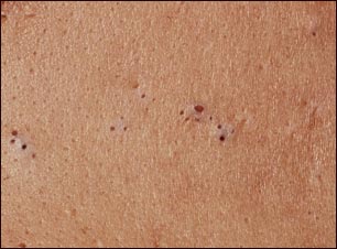 Espinillas (comedones)