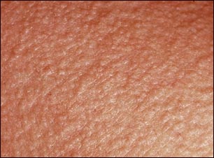 Primer plano de miliaria profunda