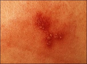 Primer plano de herpes simple