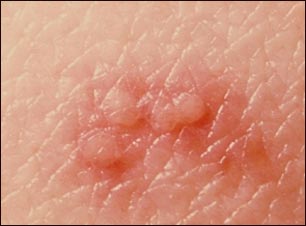 Primer plano de lesi&oacute;n por herpes zoster (culebrilla)