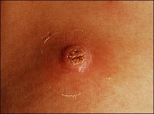 Verruga (primer plano)