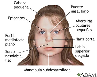 S&iacute;ndrome de alcoholismo fetal