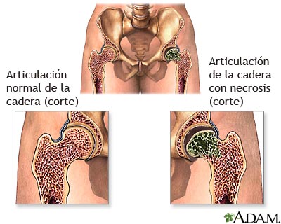 Necrosis as&eacute;ptica