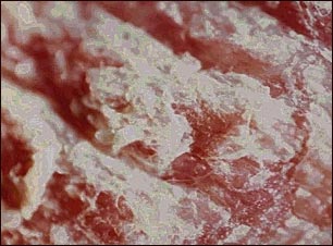 Psoriasis, magnificada por 4