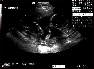 Ultrasonido de un feto normal; brazos y piernas