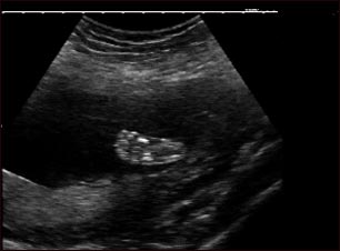 Ultrasonido de un feto normal - pie