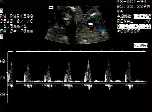 Ultrasonido normal de los latidos del feto