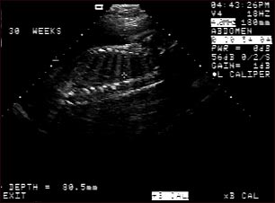 Ultrasonido de un feto normal; columna y costillas