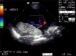 Ultrasonido normal a color -l cord&oacute;n umbilical