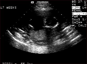 Ultrasonido de un feto normal; ventr&iacute;culos cerebrales