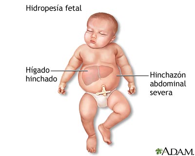 Hidropes&iacute;a fetal