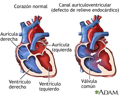 Canal auriculoventricular (defecto de relieve endoc&aacute;rdico)