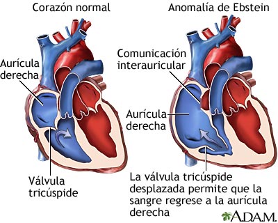 Anomal&iacute;a de Ebstein