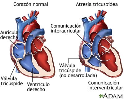 Atresia tricusp&iacute;dea