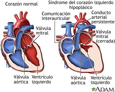 S&iacute;ndrome del coraz&oacute;n izquierdo hipopl&aacute;sico