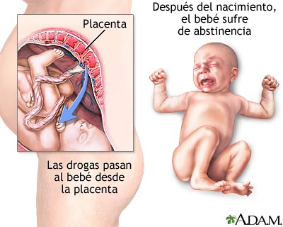 S&iacute;ndrome de abstinencia neonatal