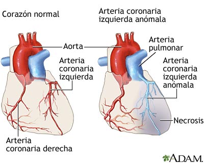 Arteria coronaria izquierda an&oacute;mala
