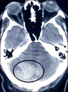 Tomograf&iacute;a computarizada de hemorragia intercerebral