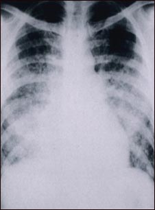 Pulmon&iacute;a aguda por varicela - Rayos X de t&oacute;rax