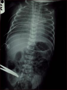 Retorno venoso pulmonar total an&oacute;malo, rayos X