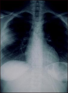 Aspergilosis - radiograf&iacute;a de t&oacute;rax
