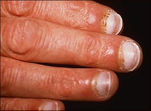 Escorbuto; hemorragia periungual