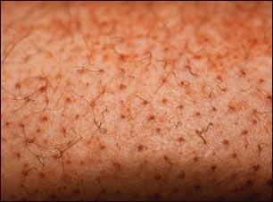 Escorbuto; pelo ensortijado