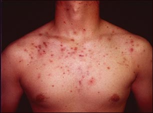 Acn&eacute; qu&iacute;stico en el pecho