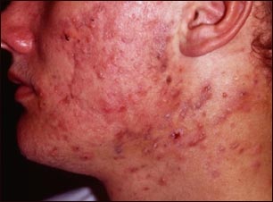 Acn&eacute; qu&iacute;stico en el rostro