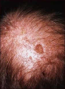 Queratosis act&iacute;nica en el cuero cabelludo
