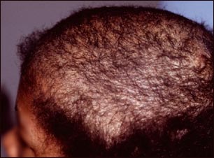 Tricotiloman&iacute;a; parte superior de la cabeza