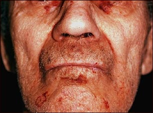 Amiloidosis en la cara