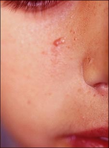 Esclerosis tuberosa; angiofibromas de la cara