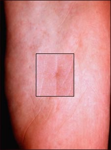 S&iacute;ndrome de nevo de c&eacute;lula basal en depresi&oacute;n plantar