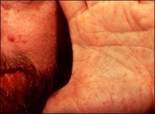 Síndrome de nevo de célula basal en cara y mano