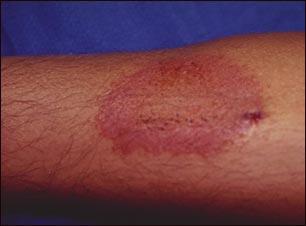 Dermatitis por contacto