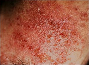 Dermatitis de contacto al&eacute;rgica; vista de cerca