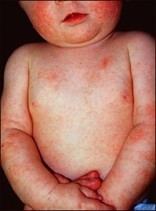 Dermatitis at&oacute;pica en un beb&eacute;
