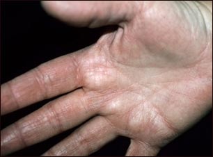 Hiperlinearidad de la dermatitis at&oacute;pica de la palma de la mano