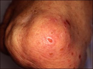 Dermatitis herpetiforme en el codo