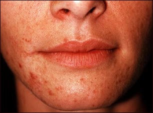 Dermatitis perioral