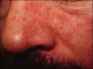 Vista de cerca de dermatitis seborreica