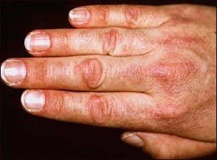 P&aacute;pula de Gottron en dermatomiositis