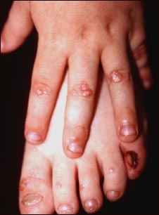 Epiderm&oacute;lisis bullosa distr&oacute;fica dominante