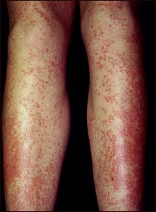 Erupci&oacute;n por drogas, Tegretol