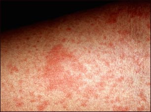 Primer plano del eczema at&oacute;pico